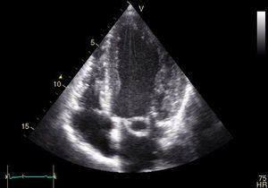 Transthoracic echocardiogram, 4-chamber apical view, showing the aneurysmal sac of the anterior mitral valve leaflet.