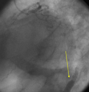 Contrast retention image on coronary angiography (arrow).