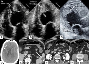 (A) Transthoracic echocardiogram, apical 4-chamber view in diastole, showing apical LV thrombus; (B) transthoracic echocardiogram, apical 4-chamber view in systole, showing the thrombus protruding into the LV cavity; (C) transthoracic echocardiogram, apical 3-chamber view, showing the LV and LA thrombi; (D) cerebral computed tomography, displaying a large cerebral infarct; (E–G) abdominal computed tomography with contrast, showing splenic (E) and renal (F) infarcts and almost total occlusion of the infrarenal abdominal aorta (G). LA: left atrial; LV: left ventricular.
