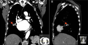 Contrast-enhanced chest computed tomography scan showing the pulmonary artery pseudoaneurysm (arrows): (A) coronal view; (B) sagittal view.