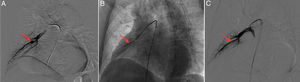 Pulmonary angiogram confirming the presence and location of the pulmonary artery pseudoaneurysm (arrow), showing its extent: (A) anteroposterior view, with stent graft implantation (arrow) to treat the pseudoaneurysm; (B) anteroposterior view, showing an excellent result with unrestricted blood flow into the periphery when the bleeding had stopped (arrow); (C) anteroposterior view.