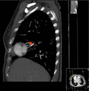 Contrast-enhanced chest computed tomography scan (sagittal view) showing the stent in the pulmonary artery without contrast leak (arrow).