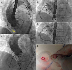 (A) Aortography with mild to moderate regurgitation (arrows) through the prosthetic aortic valve; (B) aortography showing resolution of regurgitation after removal of thrombus from the right coronary artery (CA) (due to immediate improvement of left ventricular function seen on transesophageal echocardiography); (C) acute thrombotic occlusion in the mid third of the RCA; (D) RCA with TIMI 3 flow after extraction of the thrombus; (E) thrombus extracted from the RCA after aspiration with the Pronto device.