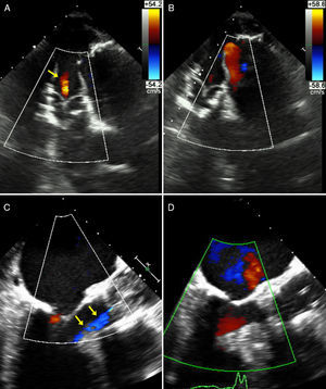 (A) Deep transgastric view at 0°: mild central aortic regurgitation (arrows) during acute ischemia and acute severe LV dysfunction; (B) deep transgastric view at 0°: disappearance of aortic regurgitation after resolution of ischemia and immediate improvement of left ventricular function; (C) mid-esophageal view at 120°: mild central aortic regurgitation (arrows) during acute ischemia; (D) mid-esophageal view at 120°: scarcely any traces of aortic regurgitation after resolution of ischemia.