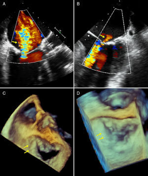 (A) Mid-esophageal view at 120°: severe mitral regurgitation during ischemia; (B) mid-esophageal view at 0°: mild mitral regurgitation after extraction of thrombus; (C) three-dimensional view of mitral valve from left atrium during acute ischemia with posterior leaflet coaptation defect; (D) three-dimensional view of mitral valve from left atrium after resolution of ischemia with recovery of posterior leaflet coaptation.