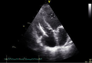 Transthoracic echocardiogram, apical 4-chamber view, showing thickening of the lead.