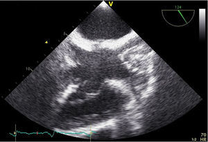 Transesophageal echocardiogram, showing a mass adhering to the lead.