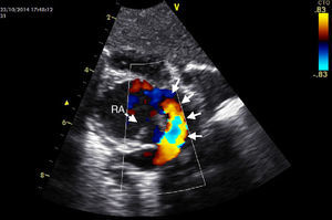 Echocardiogram in modified subcostal short-axis view showing a retroatrial conduit with connection with an enlarged coronary sinus (solid arrows). An atrial septal defect is also visible (dashed arrow). RA: right atrium.