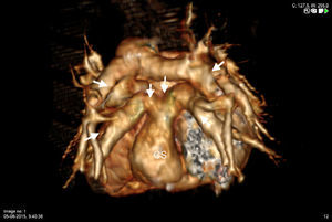 Three-dimensional computed tomography reconstruction in posterior view showing four pulmonary veins (solid arrows) draining into a retroatrial conduit (dashed arrows) and then into the coronary sinus (CS).