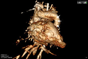 Three-dimensional computed tomography reconstruction in anterior view showing a vertical vein (solid arrows) with direct connection to the innominate vein (InV) and then to the superior vena cava (SCV).