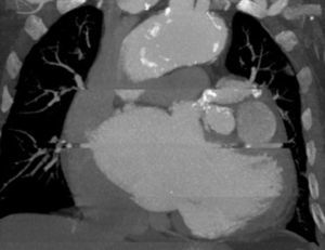 Cardiac computed tomography: a large aneurysm involving the anterior descending and circumflex arteries.