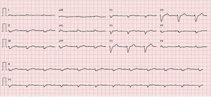 ECG showing sinus rhythm, heart rate 67 bpm, first-degree atrioventricular block, low voltage in frontal leads and complete left bundle branch block.