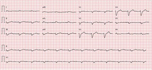 ECG showing sinus rhythm, heart rate 67 bpm, first-degree atrioventricular block, low voltage in frontal leads and complete left bundle branch block.