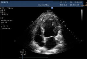 Echocardiogram, apical 4-chamber view, showing global left ventricular systolic dysfunction located mainly in the mid anterolateral and apical walls. Non-compaction is also more prominent in the subendocardial myocardium than in the subepicardial region.
