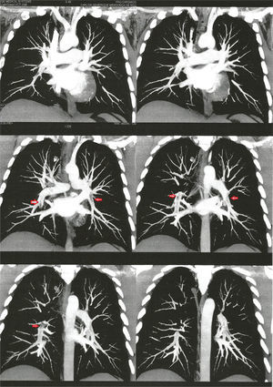 Computed tomography angiography showing signs of pulmonary embolism (arrows).