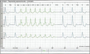 24-hour Holter ECG monitoring showing an episode of paroxysmal supraventricular tachycardia.