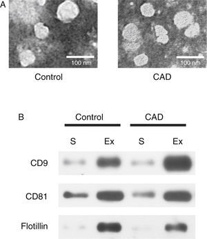 Characterization of exosomes in serum samples from Kawasaki disease patients with coronary artery dilatation (CAD) and healthy children by transmission electron microscopy and western blot. (A) Morphological characterization by transmission electron microscopy; (B) molecular characterization by western blot. Protein extracts prepared from sera (S) or exosomes (Ex) were examined using antibodies against exosomal protein markers (CD9, CD81 and flotillin).