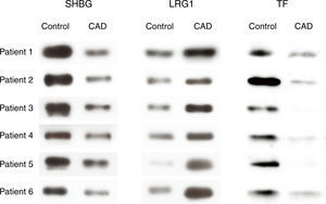 Western blot analysis for expression of SHBG, LRG1 and TF in six Kawasaki disease patients with coronary artery dilatation (CAD) and six healthy controls.