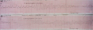 Polymorphic ventricular tachycardia (PVT) triggered by ventricular pacing (A); short-coupled (290 ms) PVT (B).