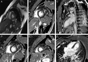 Cardiac magnetic resonance imaging: cine steady-state free precession (A) and late enhancement images, in short axis (A, B, D, E), 2-chamber (C) and 4-chamber (F) views.