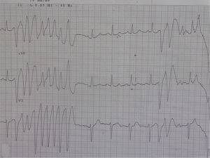 Short-coupled interval (280 ms) nonsustained polymorphic ventricular tachycardia.