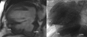 (A) Magnetic resonance images showing the presence of three ventricular cavities; (B) left ventriculography showing large bilobulated aneurysm in the inferior wall of the left ventricle. LV: left ventricle; LVA: left ventricular aneurysm; LVPA: left ventricular pseudoaneurysm.