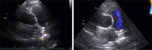 Transthoracic echocardiogram after patent ductus arteriosus closure (parasternal short-axis view): left, an image consistent with the closure device (yellow arrow); right, on color Doppler the turbulent flow is no longer seen.