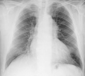 Chest X-ray, showing a slight mediastinal bulge adjacent to the aortic knuckle.