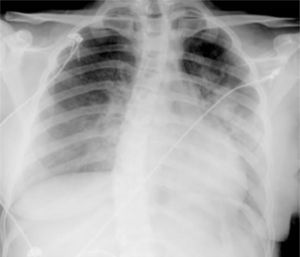 Chest X-ray at admission showing acute pulmonary edema.