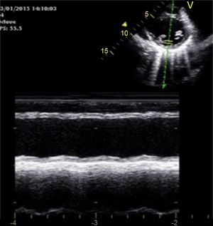 Echocardiogram at admission, short-axis parasternal view, showing global left ventricular hypocontractility.