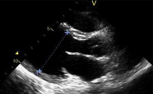Echocardiogram at admission, long-axis parasternal view, showing left ventricular dilatation.