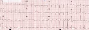 Electrocardiogram showing sinus tachycardia and ST-segment depression in V4 and V5.
