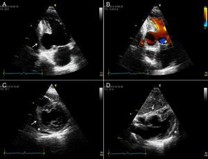 Transthoracic echocardiograms suggestive of pseudoaneurysm of the inferior wall (arrow). (A and B) Apical 2-chamber view shows aneurysm of the inferior wall with reduced wall thickness and color Doppler suggesting flow between the ventricle and the aneurysm; transverse section, parasternal short-axis view in basal (C) and subcostal (D) planes. Small pericardial effusion (*).