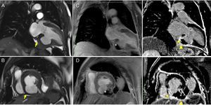 Cardiac magnetic resonance imaging. Steady-state free precession sequences in 2-chamber long-axis (A) and short-axis (B) view of the left ventricle, revealing pseudoaneurysm of the inferior wall (arrowhead) and a small pericardial effusion; (C and D) early enhancement images showing evidence of thrombus (*) partially filling the pseudoaneurysm; transmural late enhancement involving the basal and mid segments of the inferior septum and the mid segment of the lateral wall. The basal inferior segment of the left ventricular wall is composed of thrombus (*), infarct scar (arrow) and pericardium (arrowhead); (E and F) late enhancement is clearly seen on the pericardial membrane, confirming the diagnosis of pseudoaneurysm.