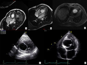 Imaging of the cyst before surgery. (A-C): Magnetic resonance imaging showing the cyst with T2-weighted hyperintense signal; (D and E): transthoracic echocardiogram showing the location of the cyst in the interventricular septum and anechogenic appearance.