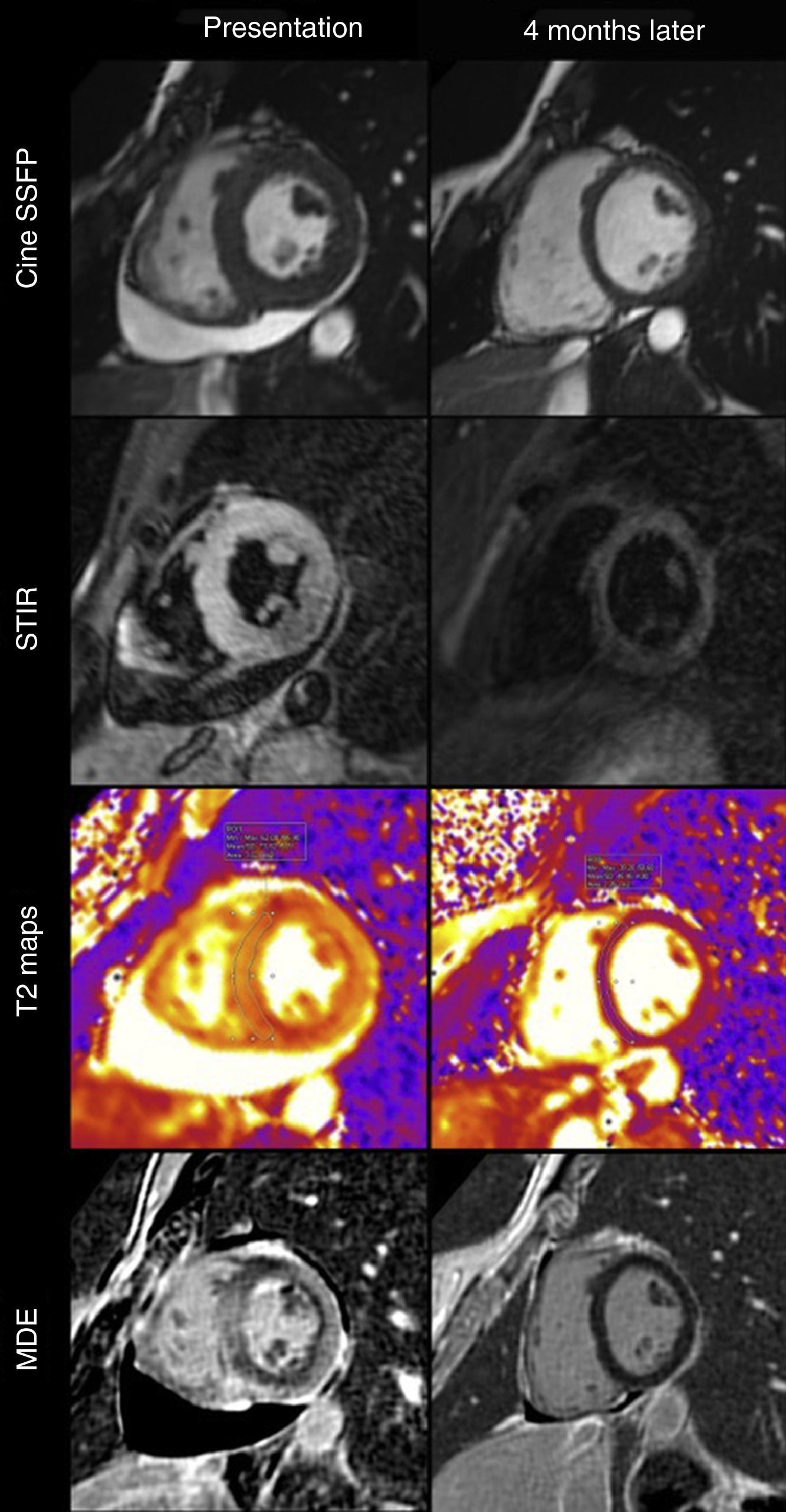 Complete recovery of myocardial inflammation imaged by T2 mapping ...
