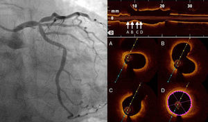 Left: initial angiography showing severe stenosis in the ostium of the left anterior descending artery; right: optical coherence tomography imaging of proximal circumflex and left main bifurcation, both free from atherosclerotic disease.