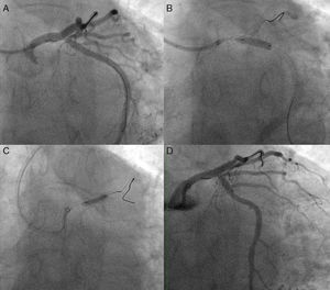 Initial percutaneous coronary intervention. (A) Circumflex jailing after left main stent deployment; (B) stent deployment in circumflex artery; (C) postdilatation of left main stent; (D) final result.