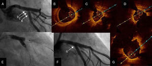 Second procedure. (A) Angiography showing ostial restenosis of circumflex stent; (B-D) optical coherence tomography (OCT) imaging assessing severity of restenosis, showing underexpansion as the underlying mechanism; (B) proximal circumflex, (C) ostial circumflex, (D) ostial circumflex and bifurcation with left anterior descending artery; (E) kissing balloon inflation; (F and G) final angiography and OCT imaging showing good result.