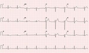 Resting electrocardiogram exhibiting sinus rhythm (60 bpm) and nonspecific repolarization changes.