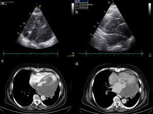 (a and b) Transthoracic echocardiogram (modified 4-chamber view) showing a left intraventricular mass measuring 59 mm×35 mm protruding into the left ventricular outflow tract, extending to the pericardium and infiltrating the left ventricular wall; (c and d) computed tomography angiography showing an intracardiac mass occupying the entire left atrium and part of the left ventricle, extending to the pericardium and compressing the inferior vena cava.
