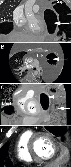 Cardiac computed tomography. (A) Coronal plane with marked herniation of the abdominal contents into the left hemithorax (white arrow); (B) the corresponding axial plane with bowel loops extending up into the thorax to the level of the main pulmonary artery; (C) coronal volume-rendered image of the bilateral diaphragmatic elevation and bowel loops within the thoracic cavity; (D) contrast-filled cardiac chambers with a thin and hypoperfused inferior wall, as typically seen in Duchenne muscular dystrophy. Ao: aorta; Diaph: diaphragm; LV: left ventricle; RA: right atrium; RPA: right pulmonary artery; RV: right ventricle; TTF: transthoracic fat.