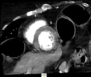 Cardiac computed tomography, multiplanar reformatted image showing the left and right ventricles in short-axis view among three loops of large bowel, giving the appearance of the Kapetanakis-Rajani/Olympic rings sign.