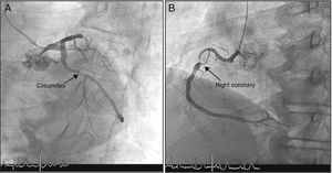 Coronary angiography: (A) circumflex with 90% lesion in the proximal segment; (B) right coronary with extensive lesion in the proximal segment, causing severe subocclusive stenosis.