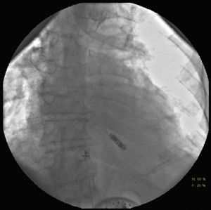 Final position of the leadless pacemaker.