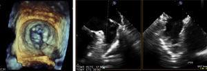 Transesophageal echocardiographic images of the stenotic mitral valve and the thrombus-free left atrial appendage with spontaneous inner contrast.
