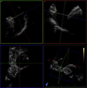 Transesophageal echocardiographic measurement of the entry orifice and length of the left atrial appendage.