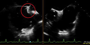 Transesophageal echocardiographic image of transseptal puncture.