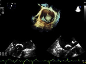 Transesophageal echocardiographic image of percutaneous balloon mitral valvuloplasty.