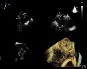 Transesophageal echocardiographic three-dimensional reconstruction of inflation and release of the Amplatzer Cardiac Plug by the left atrial appendage.